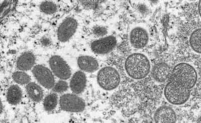 Image for Explainer-Why monkeypox cases are spreading in Europe, US