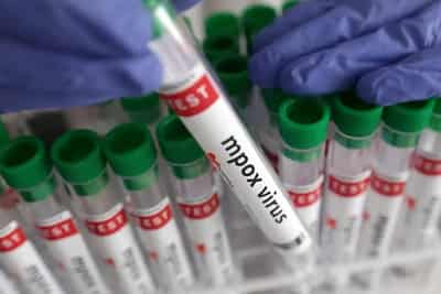 Image for New case of mpox variant clade Ib detected in England