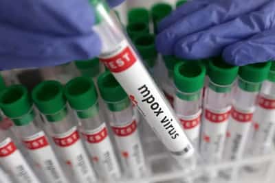 Image for New case of mpox variant clade Ib detected in England